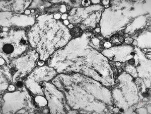 Whipple disease Whipple disease